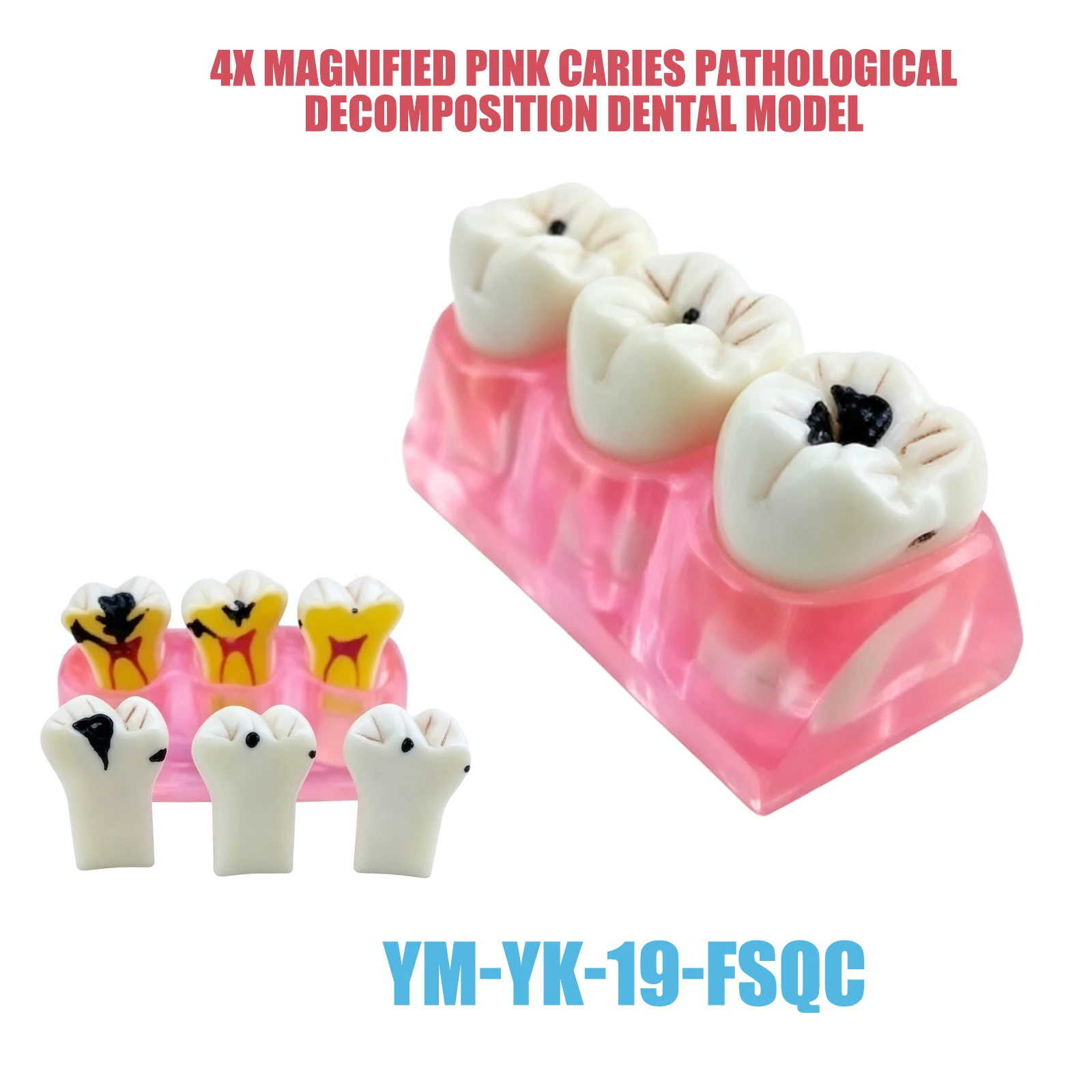 Dental Caries Model Four Stage Caries Decomposition  Pathology Study Dentist Teaching Caries Progression Demonstration Model