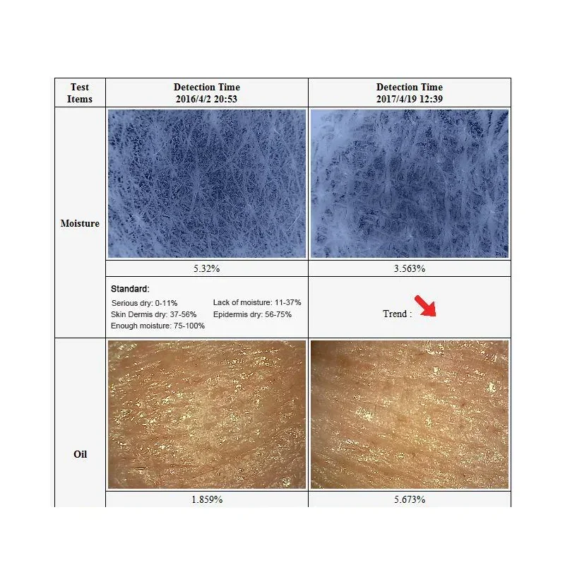 Digital facial skincarisma scope 3 layer 3D visa skin analysis dermaskin logica machine connect with computer use