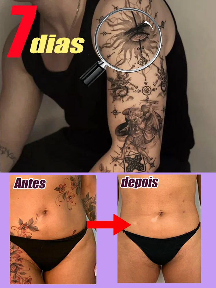 stylo-laser-pour-detatouage-elimine-les-tatouages-grands-et-petits-elimine-efficacement-les-tatouages-permanents