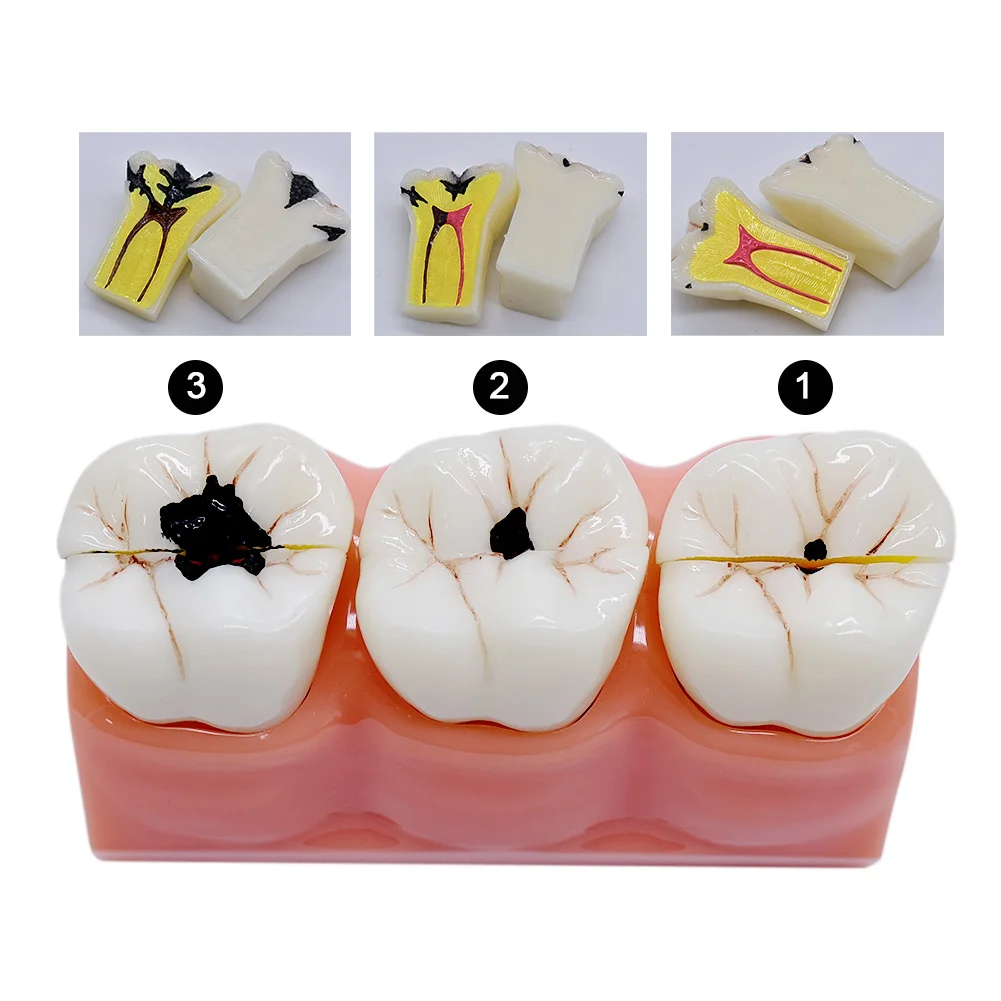 

4 Times Caries Comparation Models Caries Decomposition Dissected Teeth Model Teaching Research Study Model for Dentistry Student