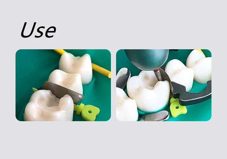 Dentales Sektionalmatrizensystem A2 Metallmatrizen NITI Klemm- und Trennring Keilmesser Diamantkeile Zangen Zahnmedizinisches Werkzeug – Detail 9