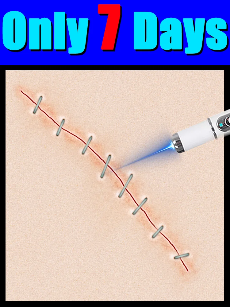 

Ручка с синим светом решает шрам, бесплатная доставка, инструменты для ухода за автомобилем, безболезненная, бесплатная доставка