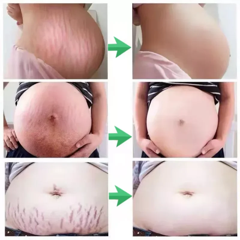 7 Days Stretch Marks Spray For Pregnancy Remove Postpartum Obesity Women Scar Without Side Effect Butt Firm Lift Skin Body Cream