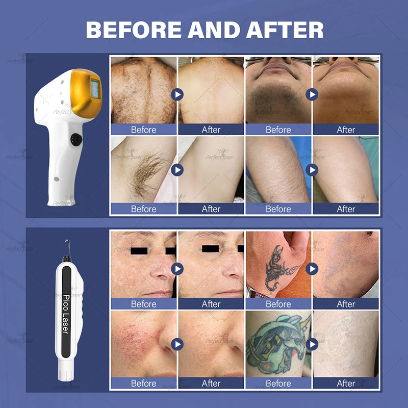 Perfectlaser 2 in 1 Picosecond Laser Tattoo Removal Diode Laser Hair Removal Machine Picolaser Pigment Lesions Wrinkle Removal