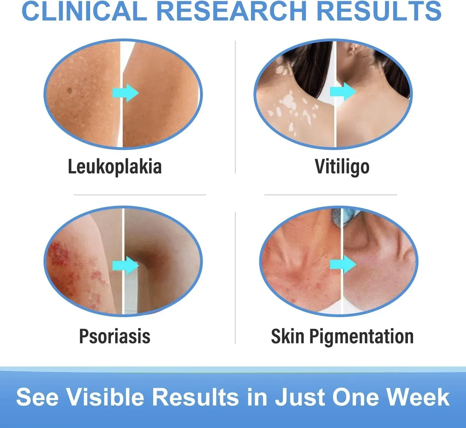 Vitiligo Behandeling Voor Huid Vitiligo, Vitiligo Verzorgingscrème Voor Het Verminderen Van Witte Vlekken En Het Verbeteren Van De Pigmentatie Van De Huid