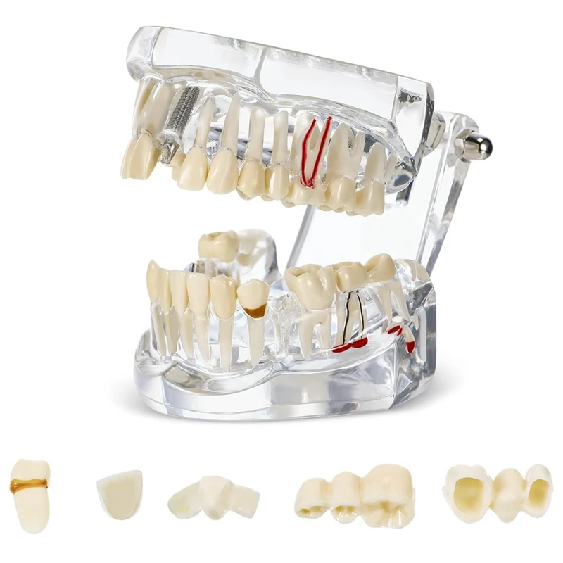 

Typodonts Implant Teeth Model With Removable Teeth Dentist Standard Tooth Demonstration