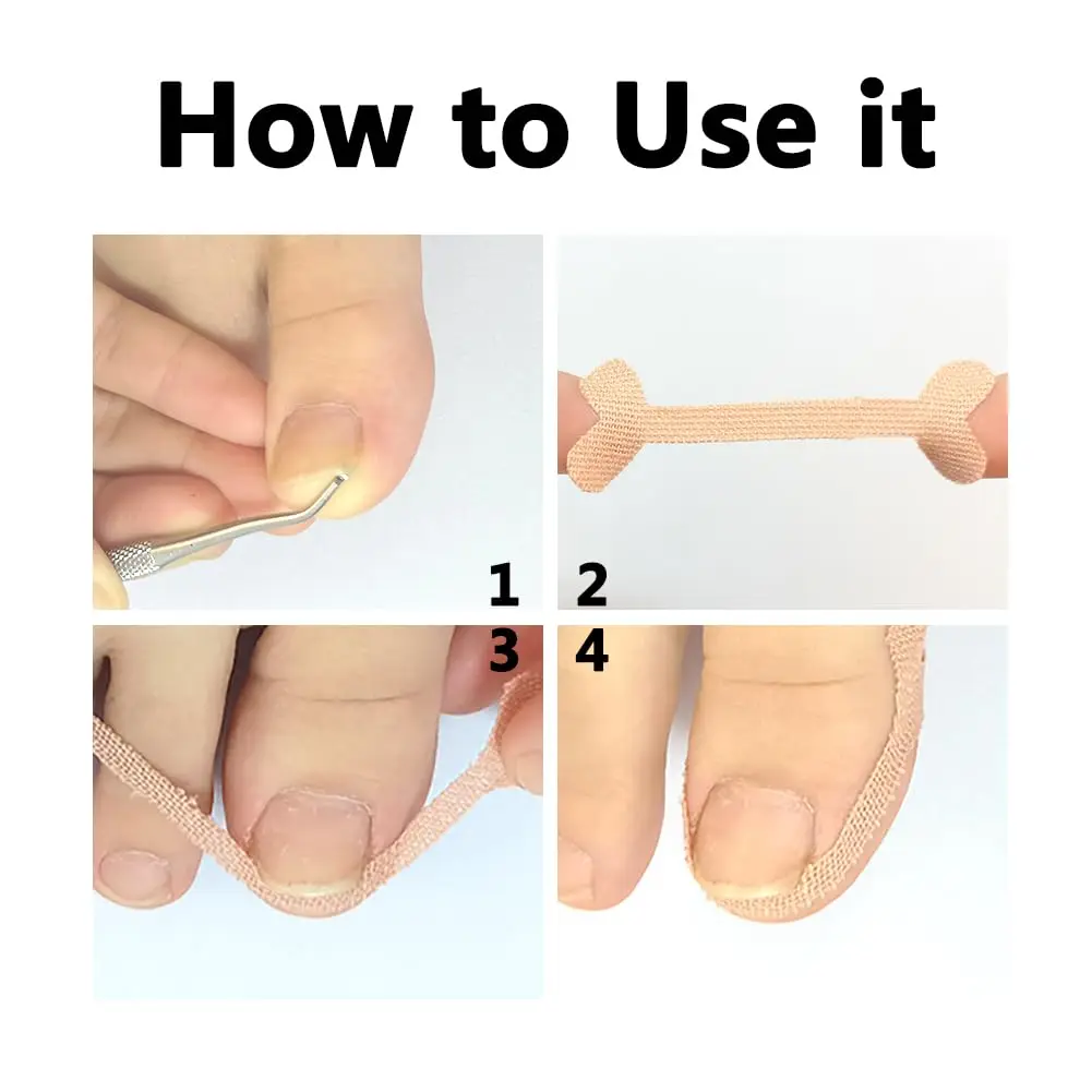 Adesivos de correção de unhas encravadas, corretor de unhas encravadas, tratamento de paroníquia, corretor de recuperação, ferramentas de pedicure