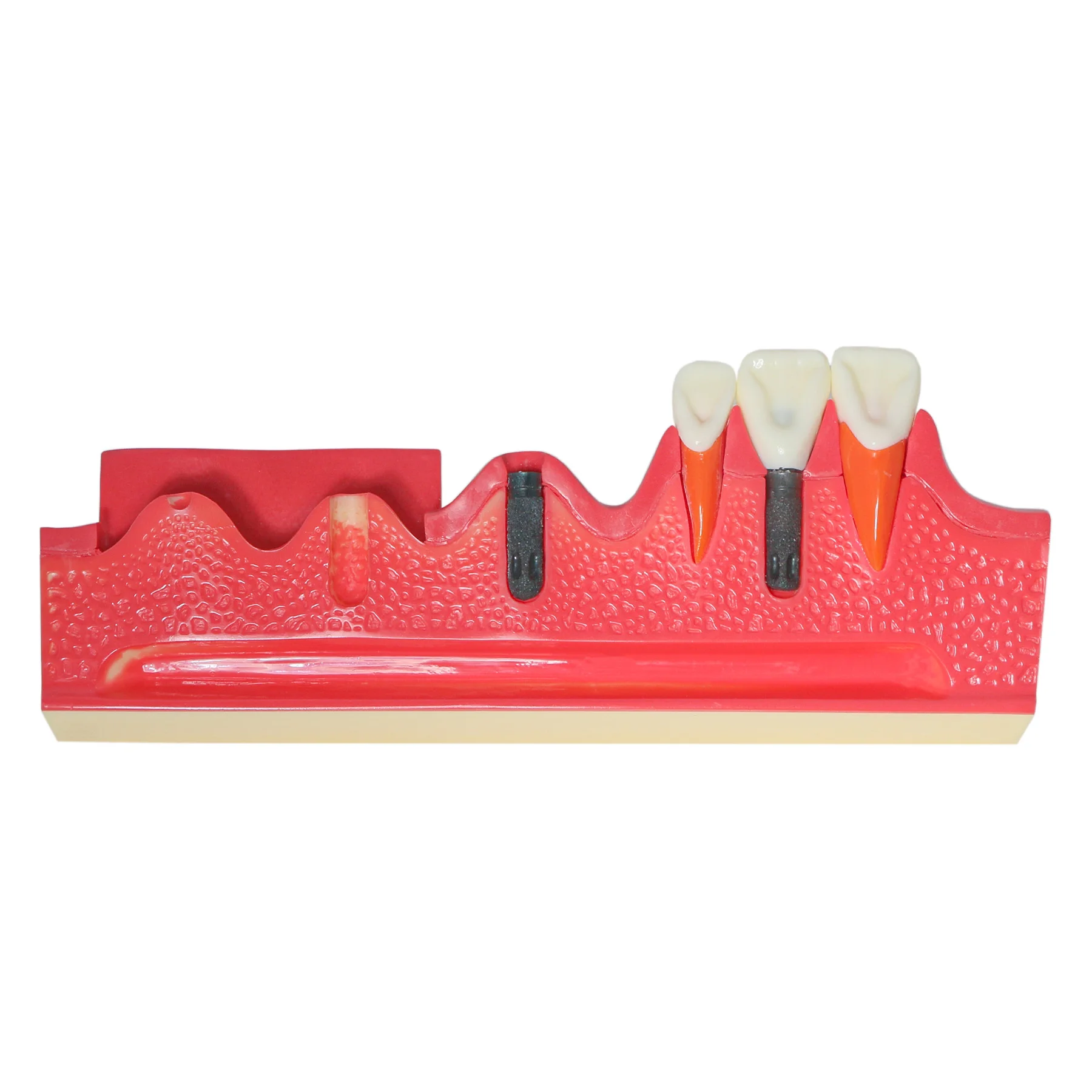 

Dental Typodont Dental Implant Model Denture Implantation Step Process Is Suitable For Dentists Demonstration Teaching