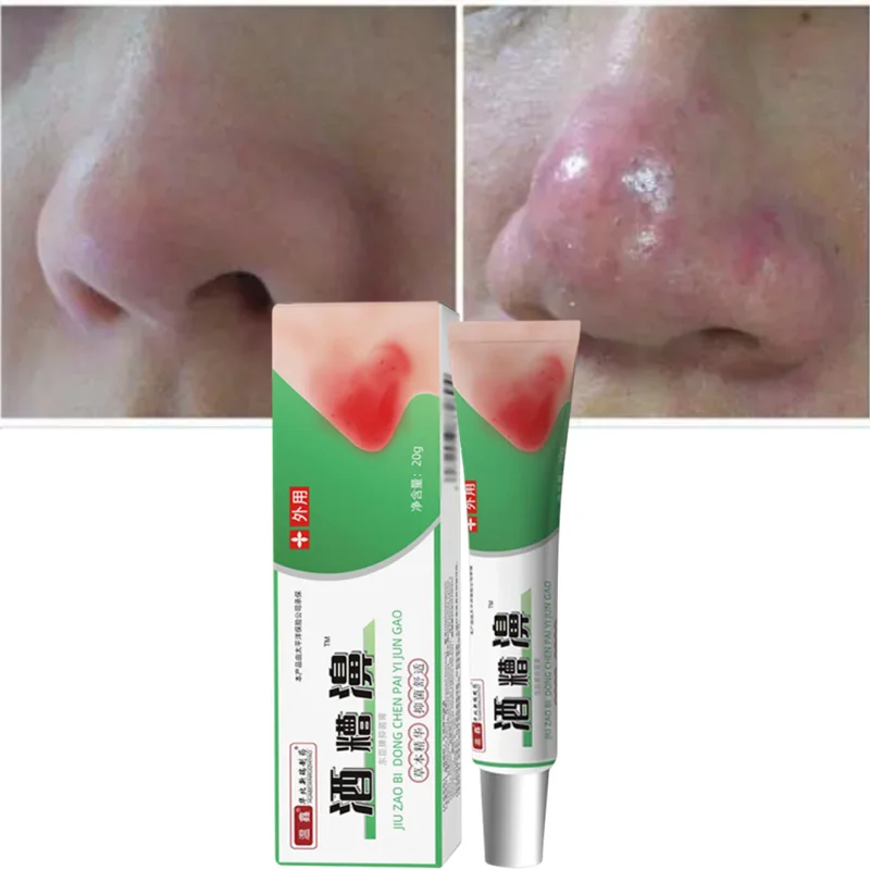 

Rosacea Cream Red Nose Ointment Remove Blackhead Acne Cream Skin Care Herbal Anti Acne and Mite Acne Rosacea Treat Shrink Pores