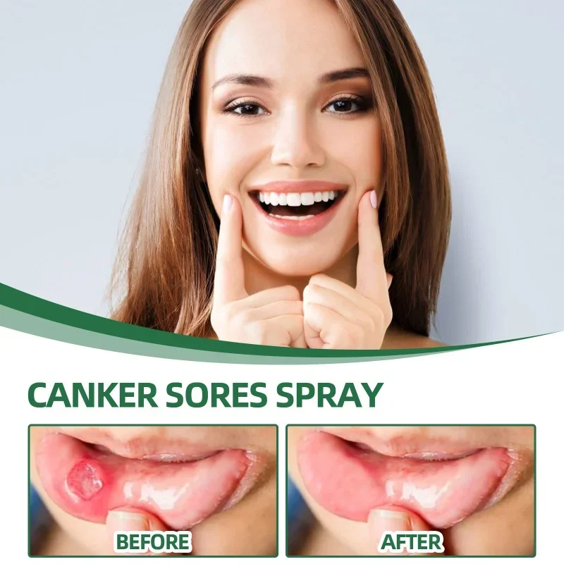 Mouth ulcer spray Treatment swollen gums oral Canker Sores Pain Relief fresh breath Antibacteria Halitosis mouth Clean care