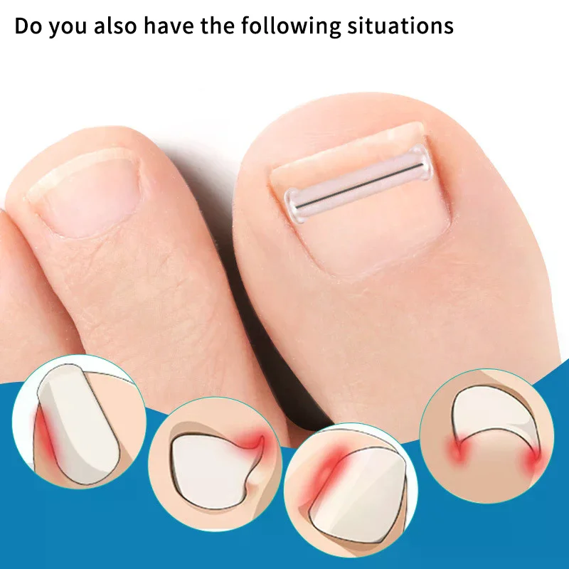 2 Stuks Nagel Correctie Stickers Ingegroeide Teennagel Corrector Patches Paronychia Behandeling Herstellen Corrector Pedicure Gereedschap Voetverzorging