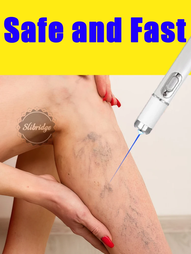 

Blue Laser Heals Leg Veins