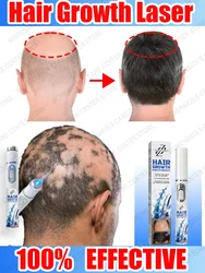 Promover a regeneração capilar caneta laser luz azul infravermelho crescimento capilar caneta anti-queda tratamento massagem couro cabeludo inteiro