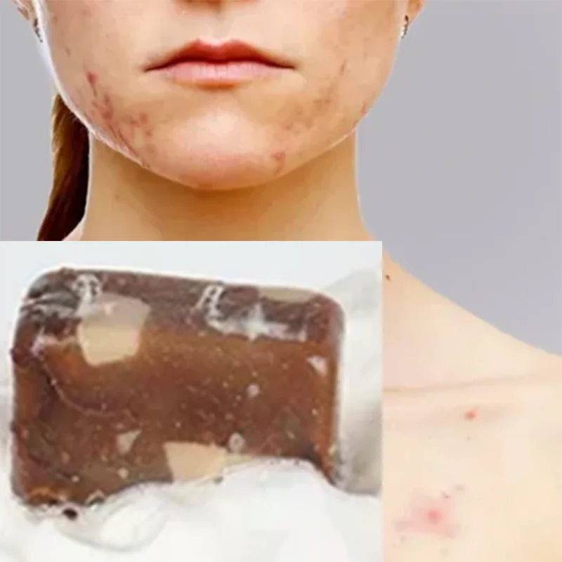 

Африканское черное мыло, масло ши, против реболлингов, увлажняющее средство от прыщей, ручная работа, красота, ванна для тела, мыло с койевой кислотой для лица