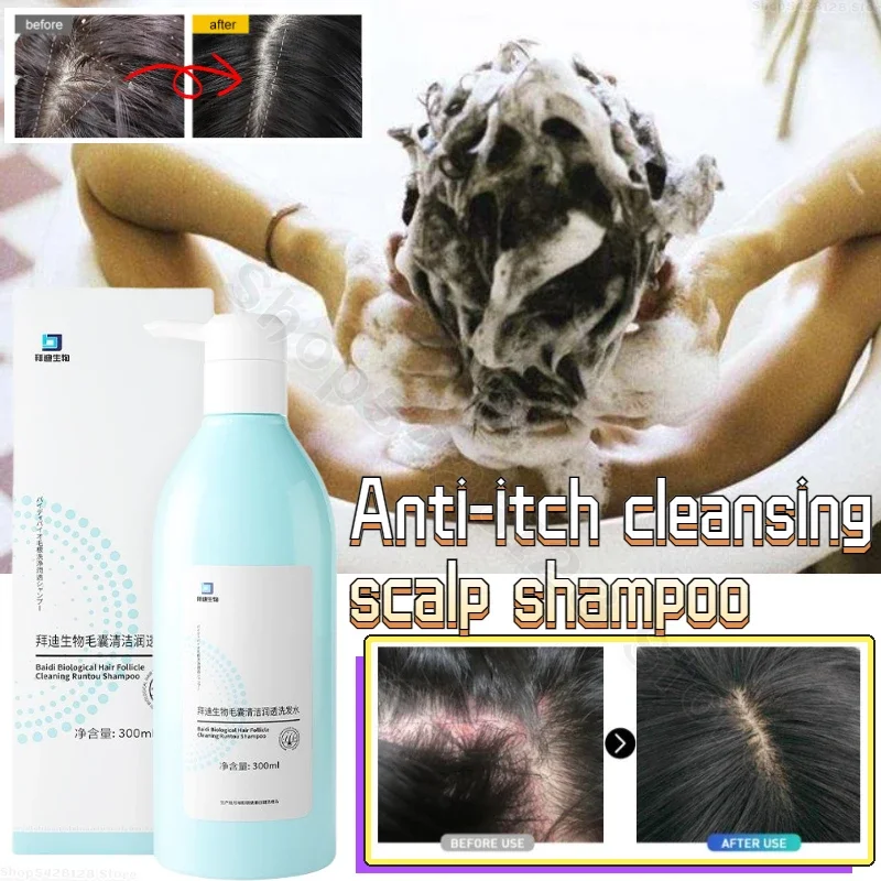 

Hair Inflammation Amino Acid Ning Shampoo Dew Repair Hair Follicle Plant Mite Removal Hair Cream Damage Repair Improve Frizz