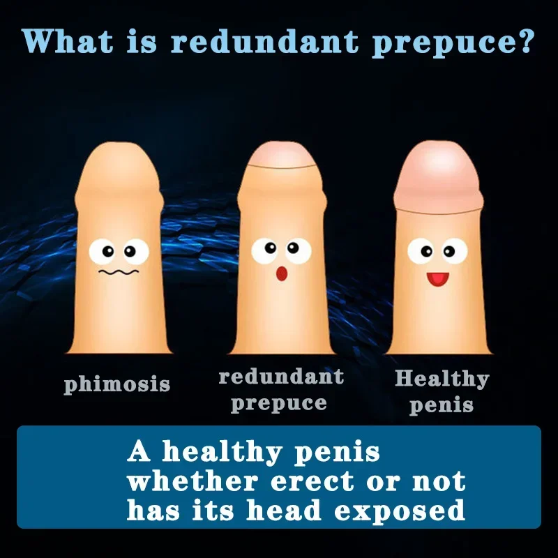 Redundant prepuce of Penis Treatment Gel Prevent Phimosis Expose The Penis Head  Without Surgery Male Prepuce Retraction Cream