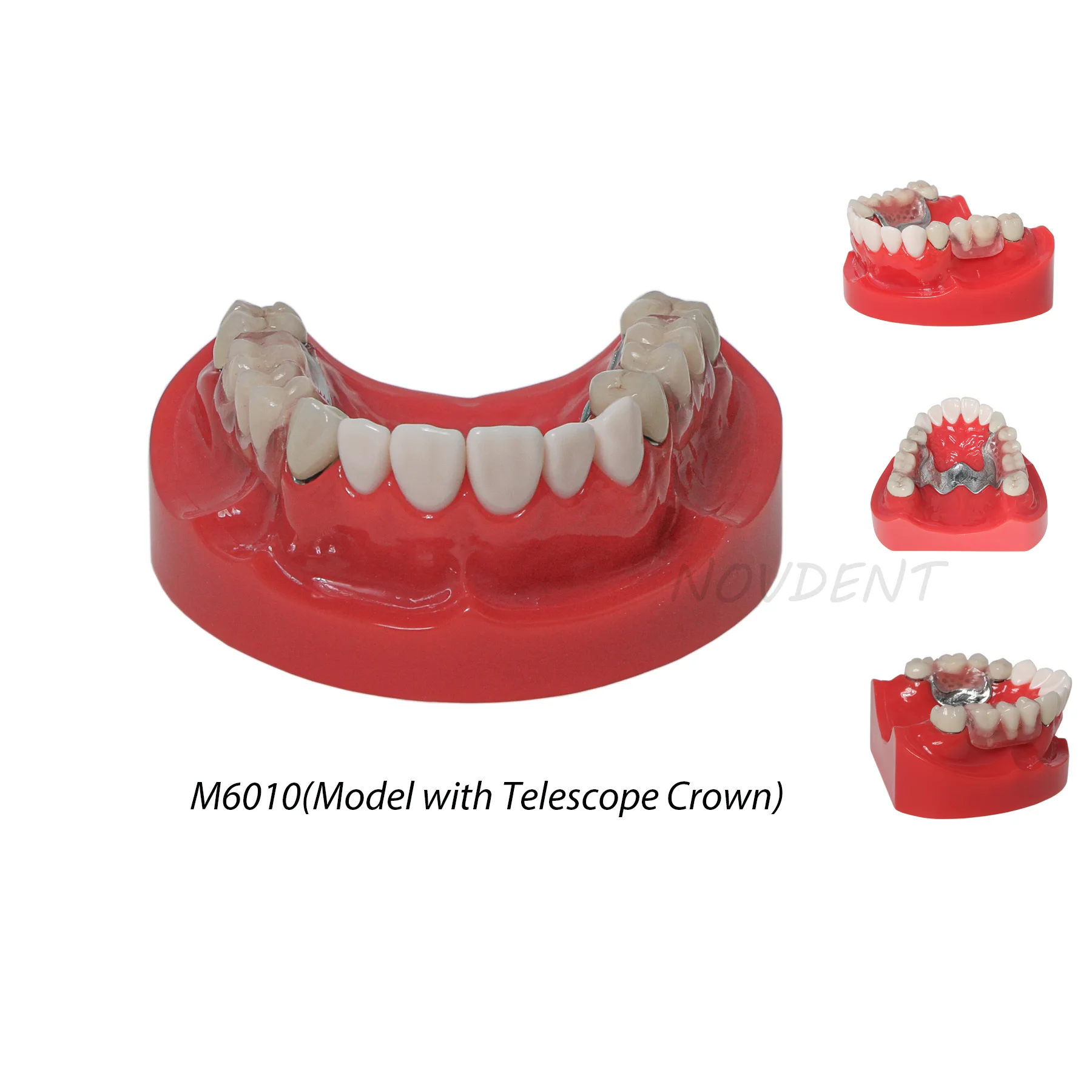 Dental Typodont Teeth Model with Telescope Crown Prosthetics Removeble M6010