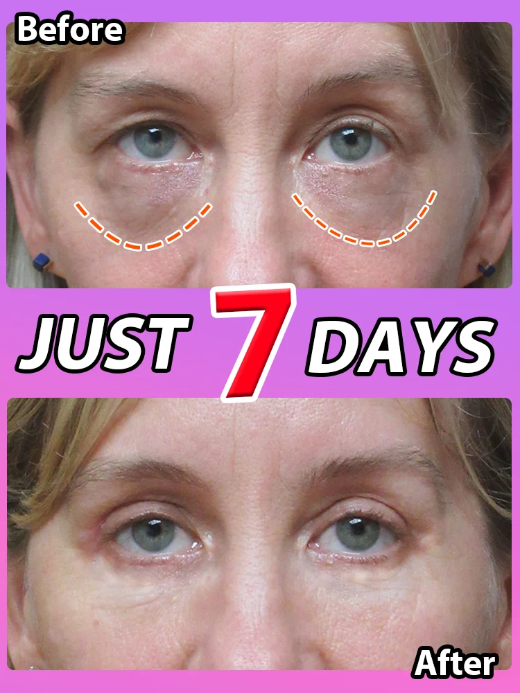 

Лучшие продукты 2025 года. Мгновенно удаляют мешки под глазами, уменьшают тонкие линии, почти подтягивает кожу, бой в темных кругах, а также осветляют глаза.