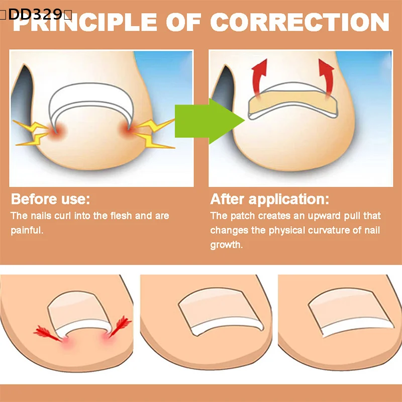 maveraDD329 Lapiza60Pcs Autocollants de Correction des Ongles Incarnés Patchs Correcteur d'ongle Patchs Traitement Récupérer Correcteur Pédicure Outil de Soin des Ongles