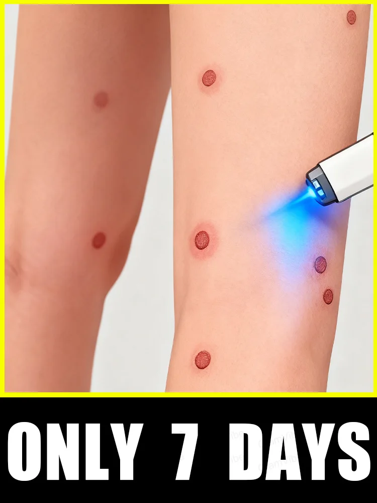 

2025 New Upgrade Blue Laser Solve Wart Tool