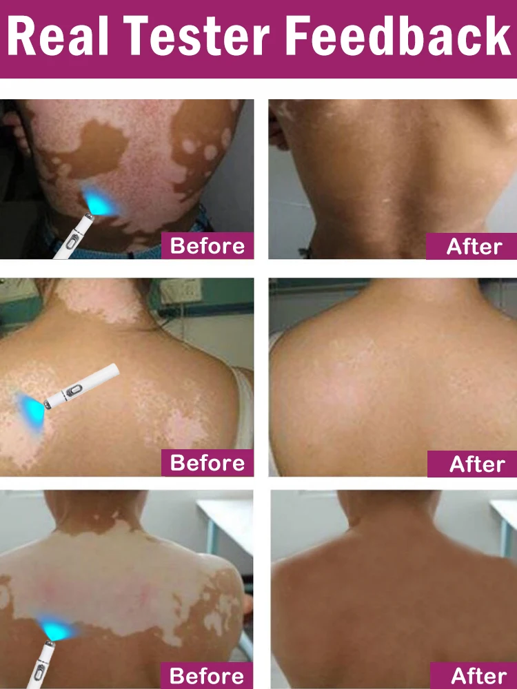 Efficient laser technology to quickly improve vitiligo - Image 3