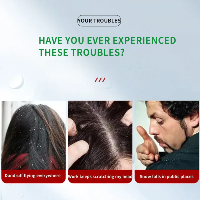 Sophora Flavescens Crema per follicoli piliferi Lenisce i follicoli piliferi danneggiati e brufoli del cuoio capelluto intasati Olio per la testa Prurito Crema sanitaria esterna