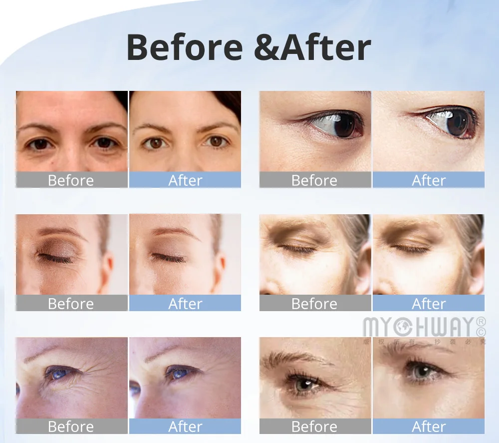 Urządzenie do mikrodermabrazji diamentowej 3 w 1 do domowego oczyszczania twarzy i pielęgnacji okolic oczu