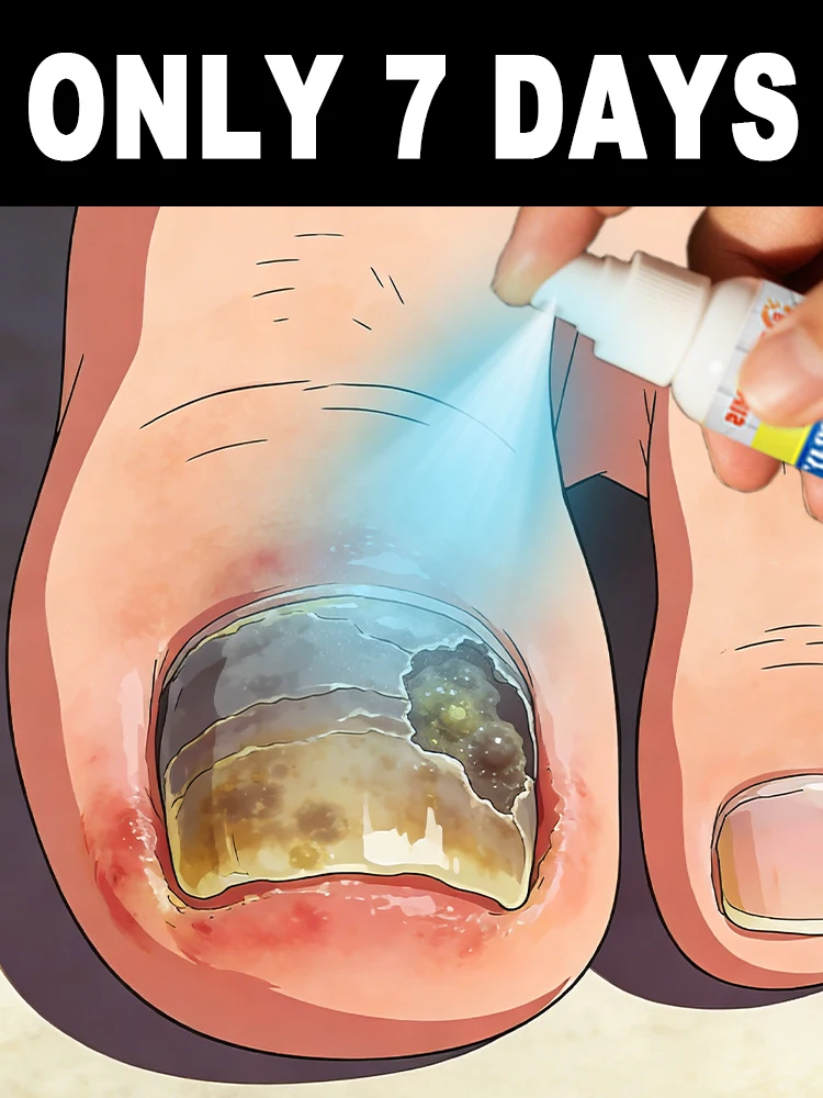 رش مرتين بعد غسل قدميك كل يوم؛ لا حاجة لتطبيق مرهم أو ضمادة