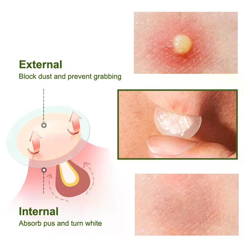 1/5Pcs Acne Patch Invisible Hydrocolloid Concealer Acne Patch Light Breathable Suction Pus Essential Oil Acne Patch