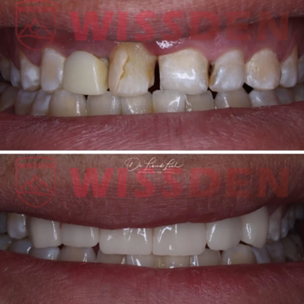 10 buah Wissden Lithium disilikat blok C14 Dental kaca keramik kubus CAD/CAM