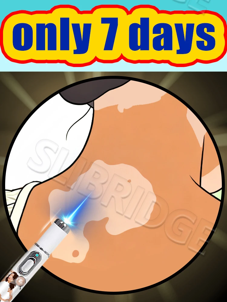 Penna a luce blu generazione-2 dice addio a tutti i vitiligine in 7 giorni