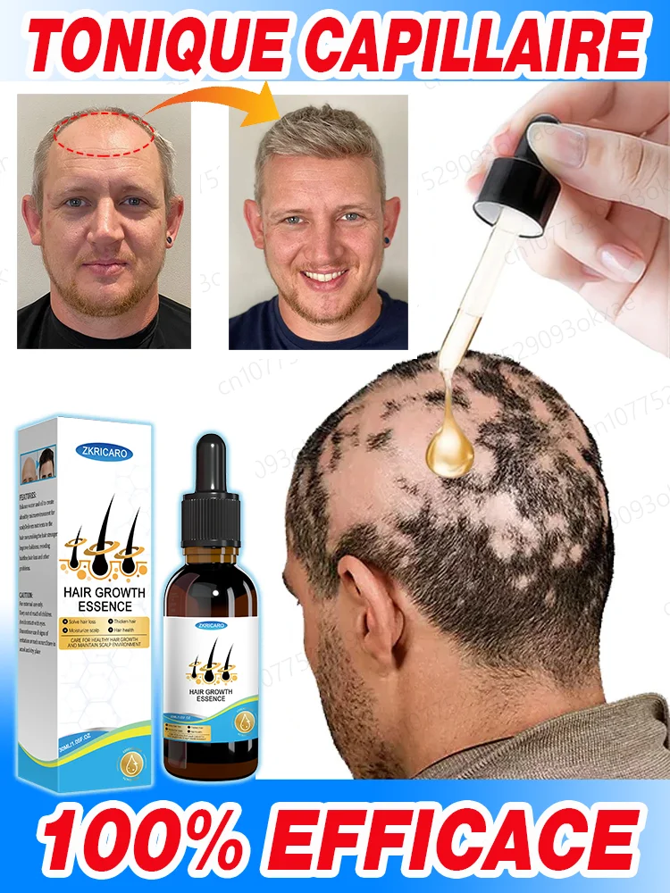 Huile essentielle de croissance Rapide des Cheveux, répare la calvitie
