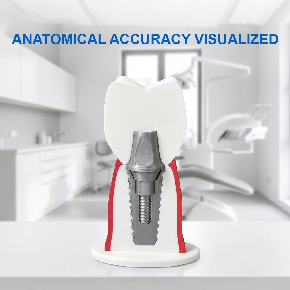 Over size Dental Implant Demonstration Model Large Detachable Tooth Implant Model for Dentist Patient Communication Study Tool