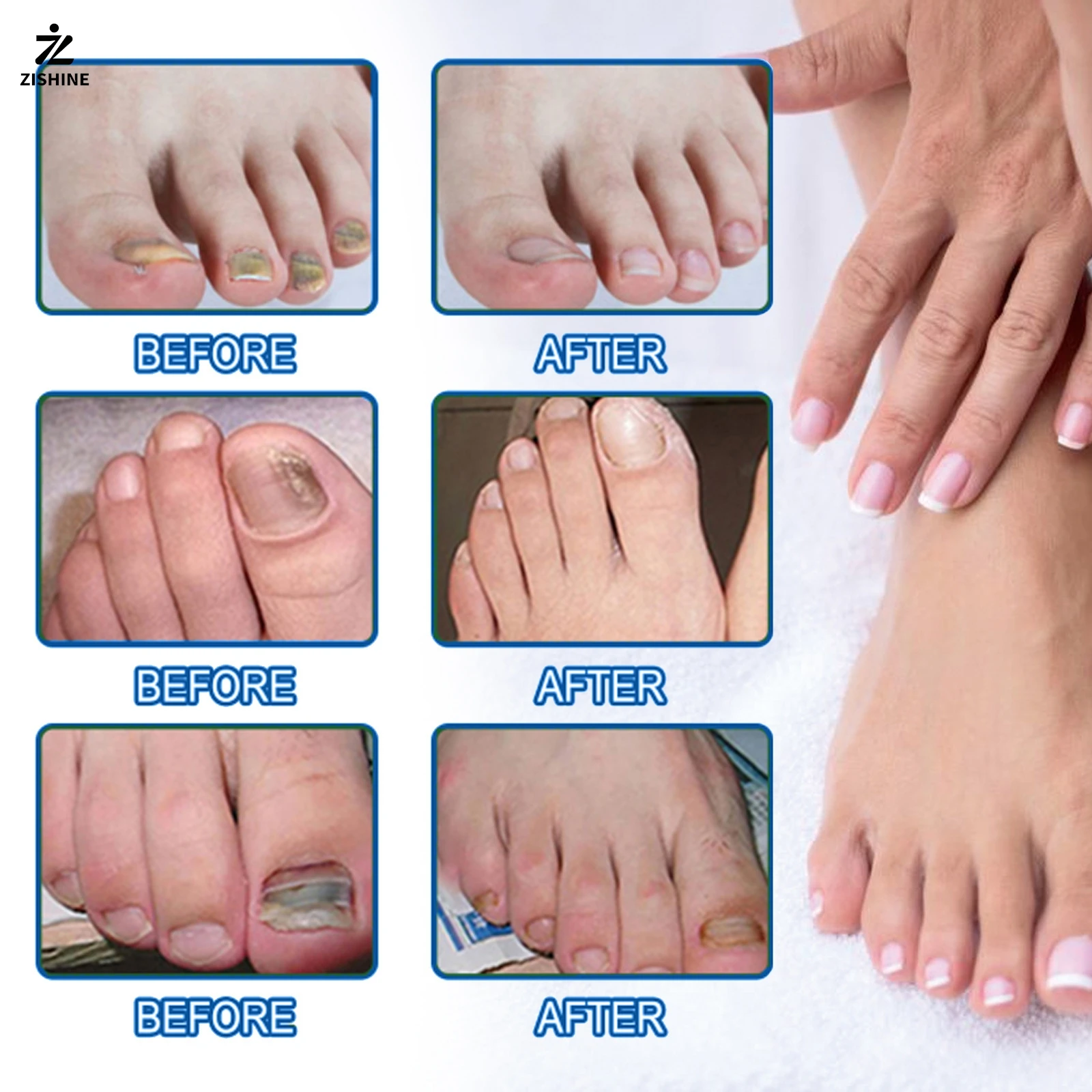 60pc-Toenail repair tape, onychomycosis, thickening, soft paronychia, infection, nail correction tape, ingrown toenails