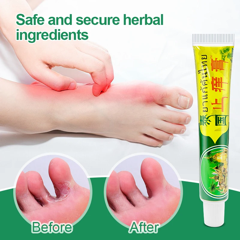 Psoriasis Removal Cream Treat Psoriasis Eczema Dermatitis Ointment Skin Allergies Cool Relief Itch Inhibit Skin Body Health Care