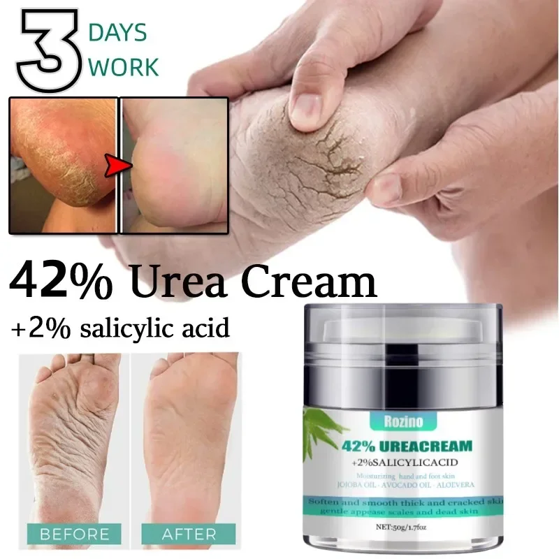 

42% Urea Cream 2% Salicylic Acid Is Suitable for Calluses Foot Cracks Heels Elbows Soften Keratin Improve Roughness Foot Care