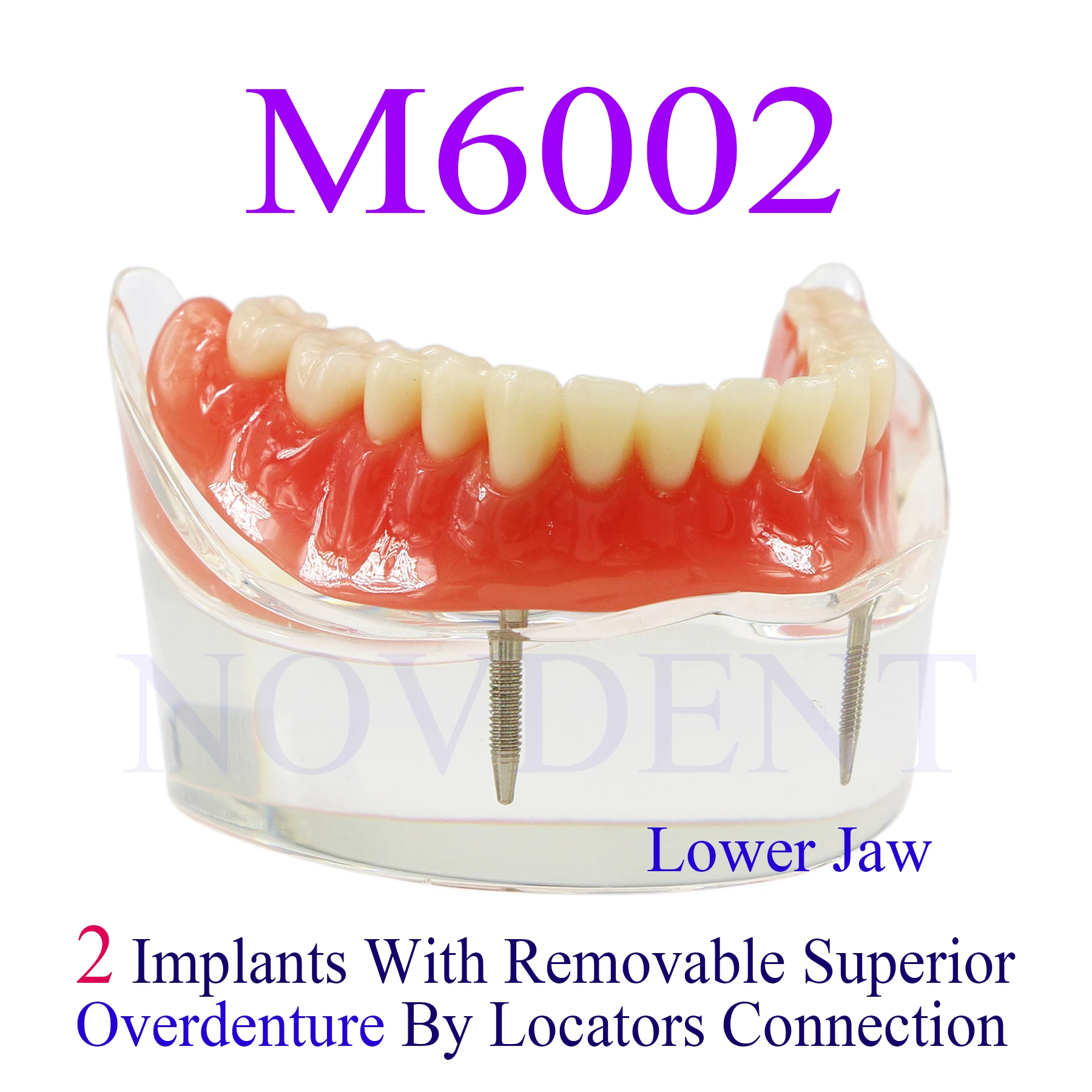 Dental dolna szczęka 2 implanty Model odbudowy Overdenture Model 2 implanty mosty edukacja badania nauczanie Student M6002