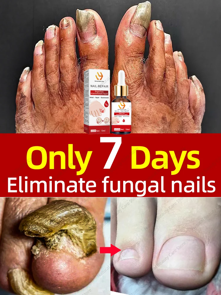 Fungal Nail Fungus Nails Repair Fast