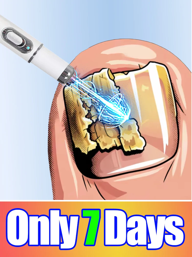 

UPGRADE Combo Set 2 The fifth generation of champagne-colored nail laser penʜᴇʟᴘs ʏᴏᴜ sᴀʏ ɢᴏᴏᴅʙʏᴇ ᴛᴏ ᴏɴʏᴄʜᴏᴍʏᴄᴏsɪs. Tᴇ