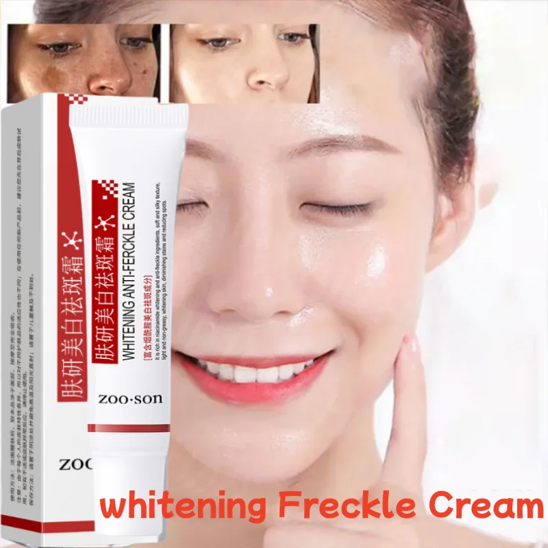 Sproet Verwijderende Crème Vrouwen Worden Geconfronteerd Met Snelle Donkere Vlekken Pigmentatie Verwijderen Whitening Cream Fade Melasma Fleuren Crème Voor Donkere Huid