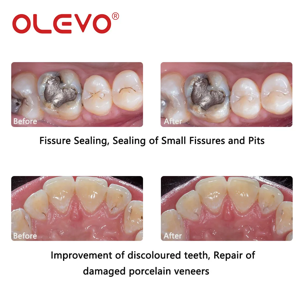 مواد راتينج الأسنان 2 جرام/قطعة علاج الضوء مركب الراتنج نانو السائل تدفق جميل F02 F10 طب الأسنان ملء استعادة الأسنان #5