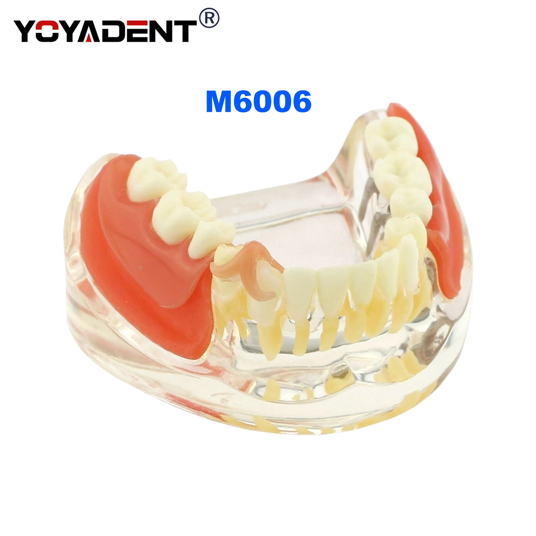 

Dental Teeth Model 3-unit removable bridge implant /restoration treatment Model Dentists Teaching Demo Model