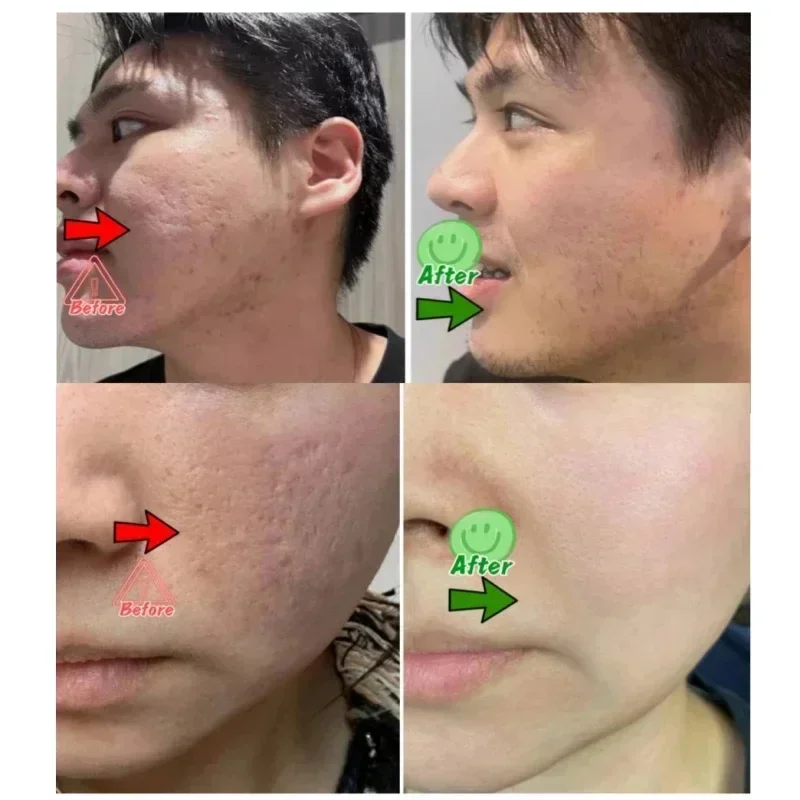 サリチル酸毛穴クリアリングクリーム毛穴を縮小黒ずみ除去にきび明るく保湿スムーズなスキンケア韓国製品