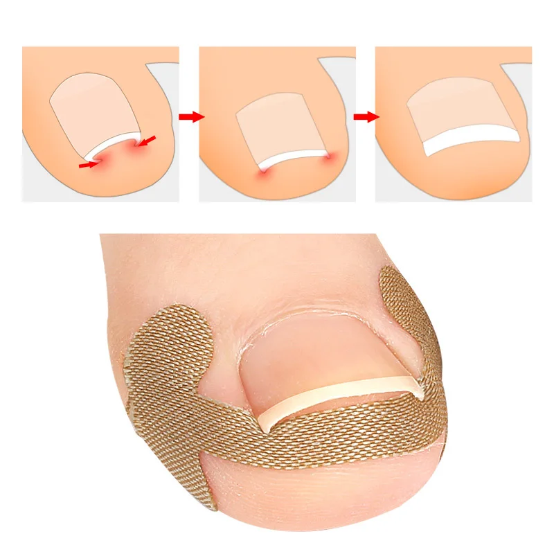 500Pcs Toenail Groove Inlaid Pedicure Orthotics Thumb Curl Patch Quick Pedicure Deformable Meat Pack