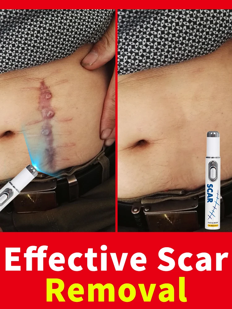 

Hot Selling Laser Scar Repair Keloids.