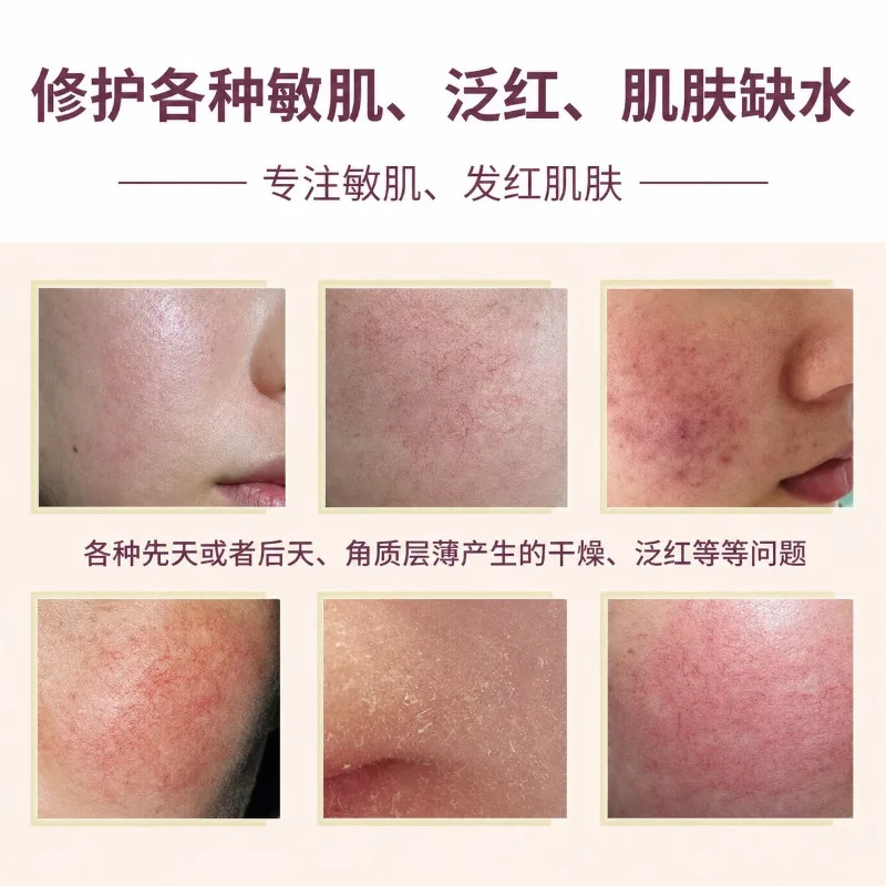 Repair Facial Redness Cream Instant Spider Vein Remove Sensitive Skin Sooth Anti Redness Rosacea Treat Lotion Korean Cosmetic