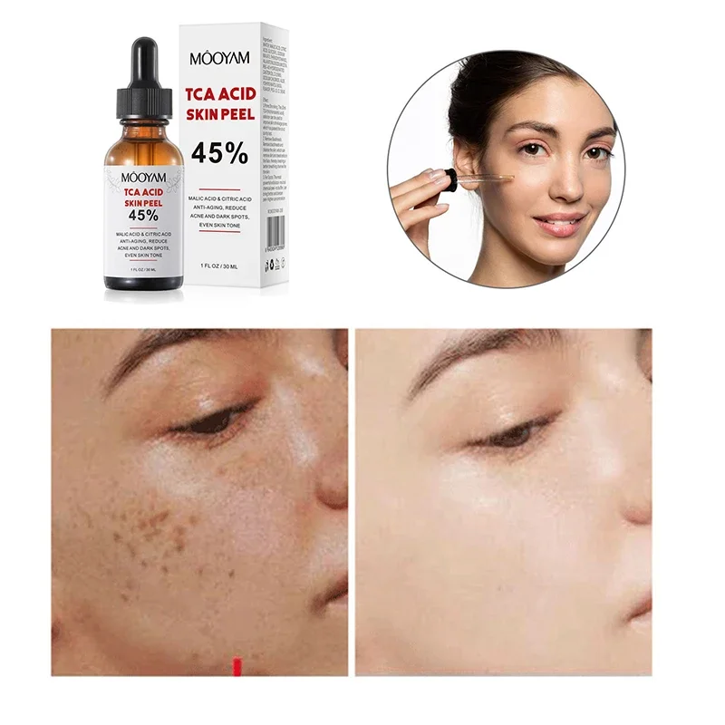 Chemical Peel Tca Peel Acid Peeling Acid 7-15 Days Delivered Skin Superforce Peeling Pigmentation Acne Scar BrightenSkin