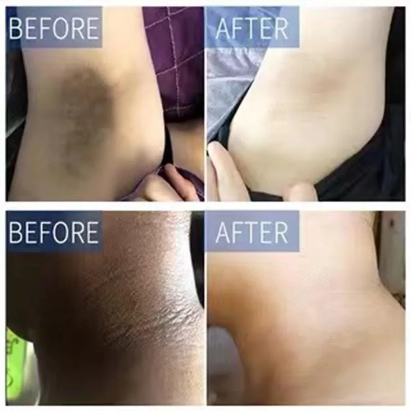 كريم تبييض الجسم أجزاء خاصة تحت الإبط الركبة الفخذ الميلانين الداخلي تبييض سطع غسول الجلد الداكن صحي الأبيض العناية بالجسم #2