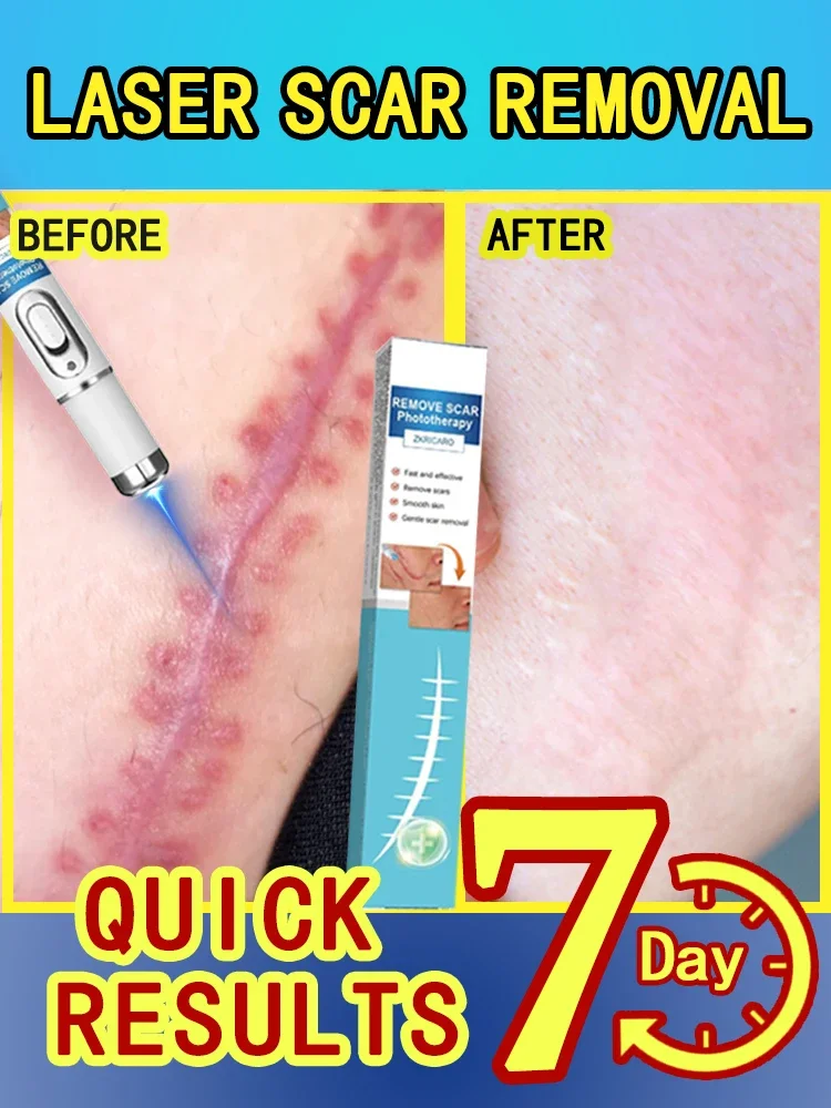 sᴄᴀʀACNE SCARS,SURGICAL PRINT,SCARS HYPERPLASIA,STRETCH MARKS,BURNS AND SCALDS,SCAR ATROPHY