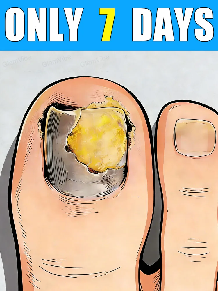 

ᴺᵃⁱˡ ᶠᵘⁿᵍᵘˢ ᵗʳᵉᵃᵗᵐᵉⁿᵗ!Say Goodbye to Yellow Dullness